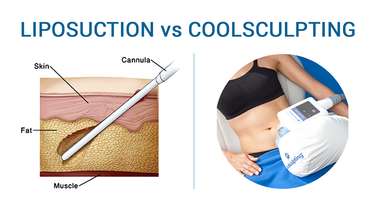 https://www.houstonplasticsurgery.pro/wp-content/uploads/2023/01/Liposuction-vs-CoolSculpting.jpg