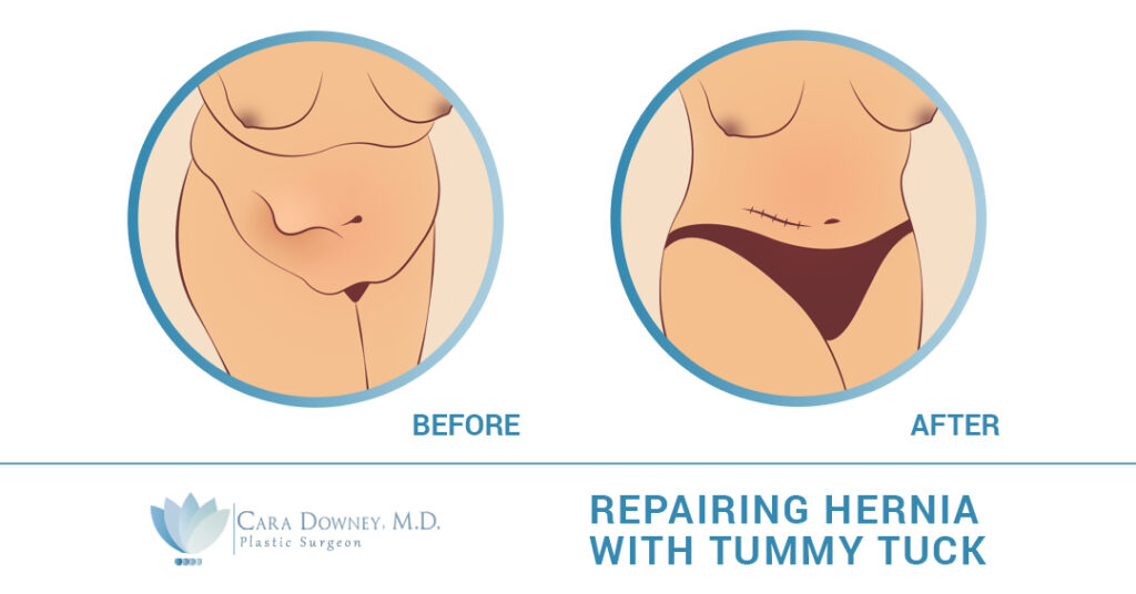Tummy Tuck Hernia Repair: What You Need To Know - Heights Plastic