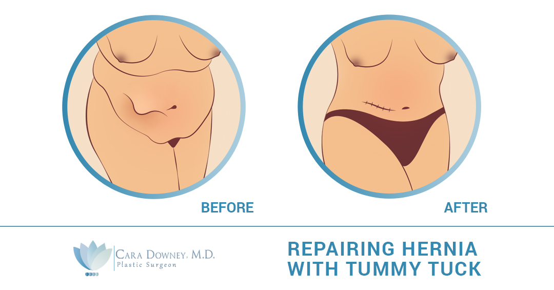 Tummy Tuck Austin Tx